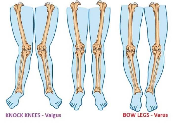 Hiện tượng knee valgus