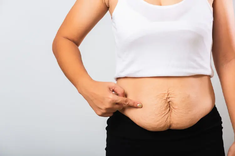Cách xử lý da nhăn nheo và chảy xệ sau khi giảm cân